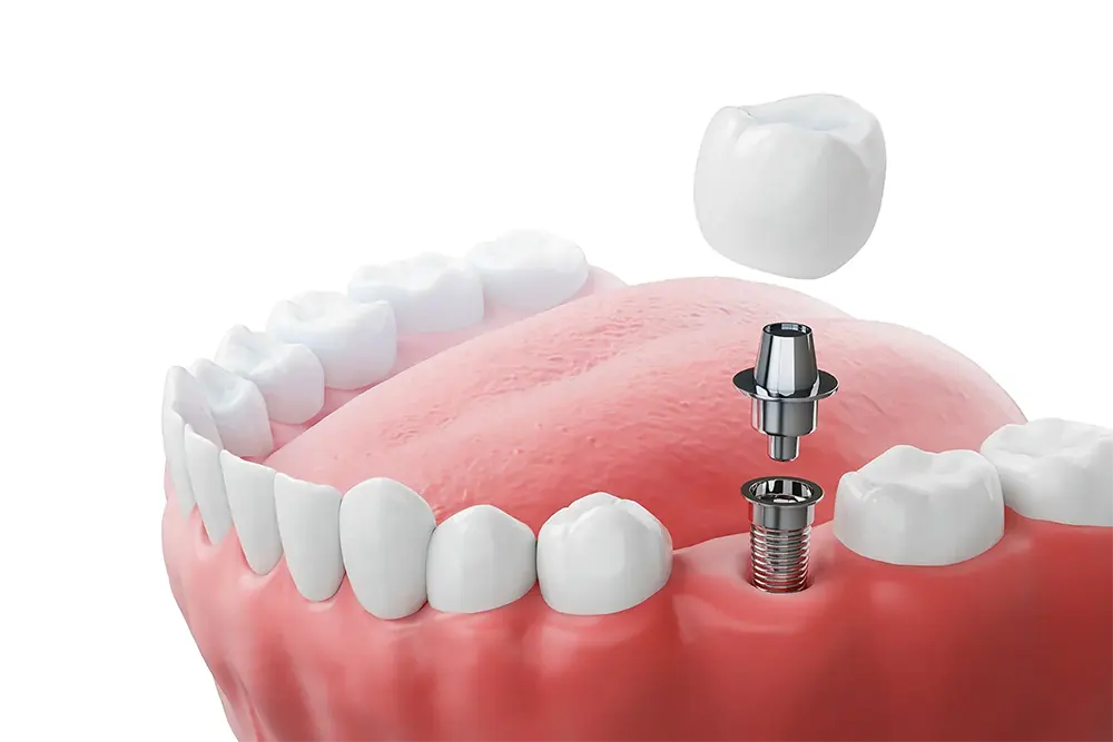 Implantes dentários